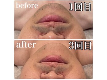 バベル(BABEL)/3回照射後のビフォーアフター☆