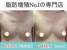 サラエクセレント 銀座/やせ型でもふっくらバストアップ