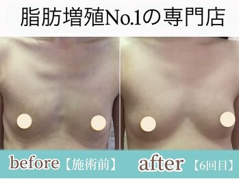 サラエクセレント 銀座/やせ型でもふっくらバストアップ