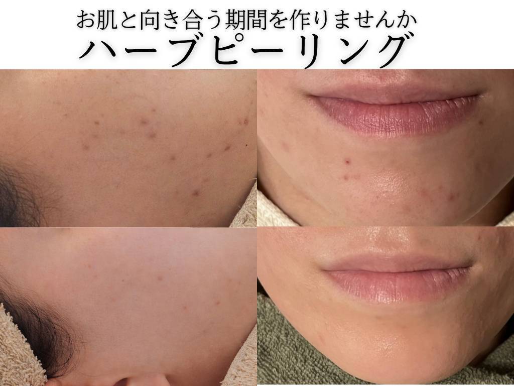 ハーブピーリング ジプソフィラフィフティドット(gypsophira15.)｜ホットペッパー