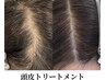 育毛促進頭皮ケア（相談と施術）4.5月限定¥40,000