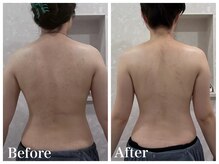 ノア 新宿(Noa)/ラジオ波＋小顔矯正　6回