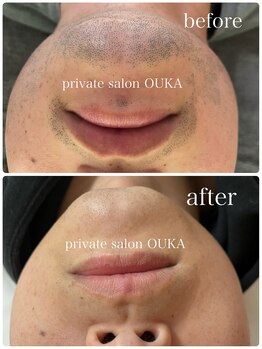 オウカ(OUKA)/髭脱毛のビフォーアフターです