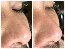 シェミー(CHEZ MEE)/【メンズ美容】毛穴洗浄/黒ずみ