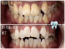 札幌セルフホワイトニング ラディアンス(Radiance)/ホワイトニング2ヶ月通い放題