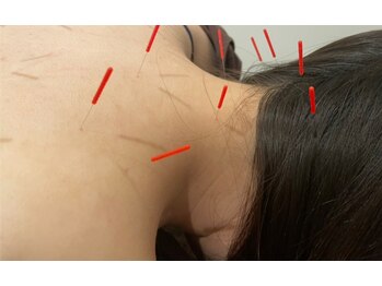 トゥービー(TWO-B)/頑固な肩コリ首コリに！！