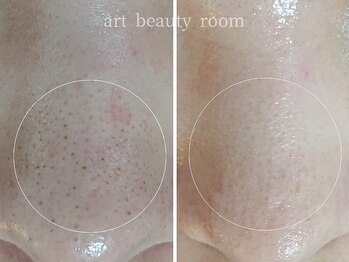 アート ビューティールーム(art beauty room)/美肌計画 毛穴・角質・角栓ケア
