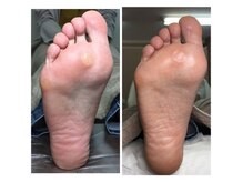 厚木 海老名 巻き爪矯正センター/事例【ドイツ式フットケア】