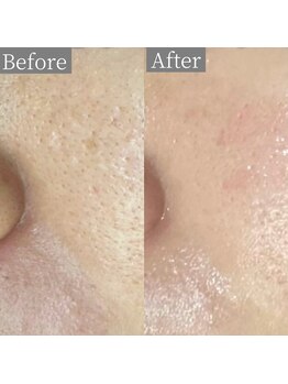 ホワイトアクア 鳳店(WHITE AQUA)/ララピール/大阪/鳳/毛穴/ツヤ肌