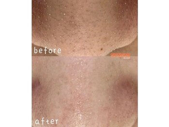 センガン(SENGAN)/つるんと透明感のある肌へ