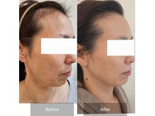 【究極の美肌プログラム】何をやっても変わらなかった肌を改善へ