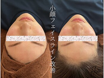 フレキシ 表参道(Flexi)/ピーリング＋小顔矯正