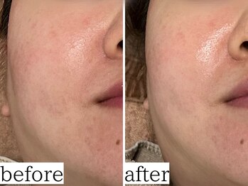 アンドナップ(nap)/大人の肌質改善