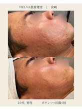 ヴィエルバ(VIELVA)/お肌の凹凸・跡