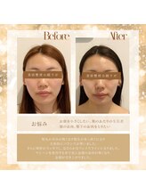 美容整骨小顔ラボ/ビフォーアフター