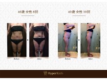 ハンズ鍼灸接骨院小牧院 美容整体ハンズ(美容整体hands)/ハイパーナイフbefore after