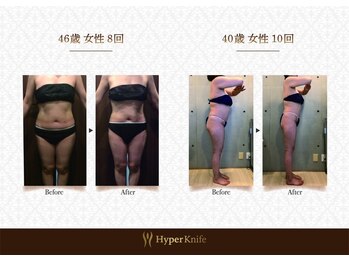ハンズ鍼灸接骨院小牧院 美容整体ハンズ(美容整体hands)/ハイパーナイフbefore after