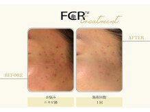 ハーバル 新宿店(HERBAL)/最強★韓国FCRハーブピーリング