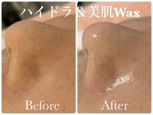 ヌー 栄(nuu)/ハイドラフェイシャル＆美肌Wax