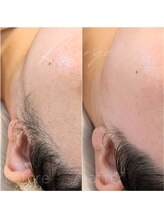 リバージュ(Riverge)/フェイシャルwax