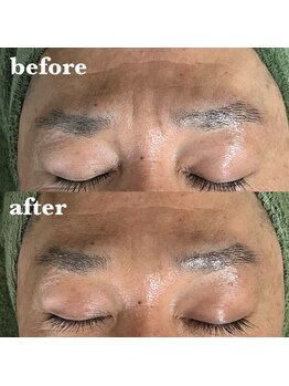 リーフィア(Leafia)/長年悩んだ大シワにも◎