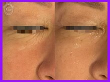 ヴィオール 名古屋栄店(VIOR)/目元にハリがでて明るい印象に♪