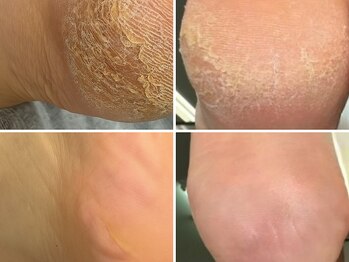 モーダアッカ(moda acca)の写真/《烏丸/四条》韓国式角質フットケアで足裏つるん♪固いかかとが柔らかふわふわに！メンズも◎