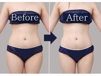 サロンドモフィ(salon de moffy)の写真/「最新脂肪冷却」×「脂肪燃焼剤同時使用」で気になる部分ケアから全身サイズダウンも◎近鉄四日市/痩身/四日市