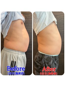 ファビー(Fabby)/マグフォース5回のビフォアフ