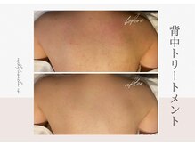 オートクチュール エステティックサロン シーズ/背中トリートメント