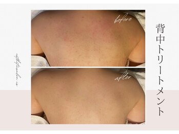オートクチュール エステティックサロン シーズ/背中トリートメント