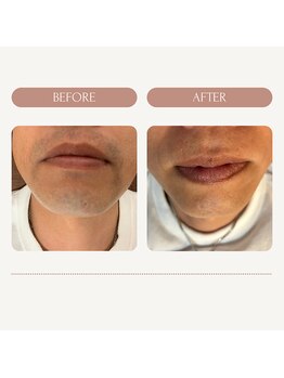 マリーローランメンズグレース(Marryrolan MensGrace)/ヒゲ脱毛15回