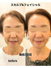 リプレサ バイ エステマニア(Ripresa)/ビフォーアフター