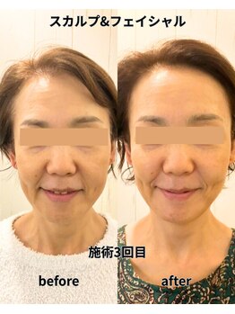 リプレサ バイ エステマニア(Ripresa)/ビフォーアフター