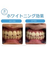 R24 梅田店/ホワイトニング効果