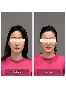 プライミー(PRIMY)/お得3点ビフォーアフター