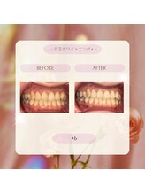 プラスビー 2号店(+b)/ホワイトニングビフォーアフター