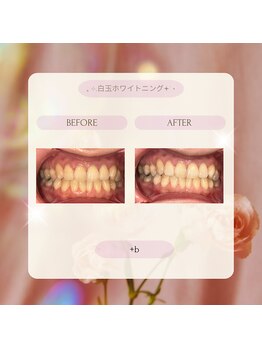 プラスビー 2号店(+b)/ホワイトニングビフォーアフター