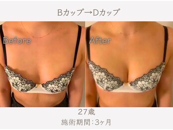 ハリスタ 京橋院(HARISTA)/BEFORE AFTER【バストアップ】