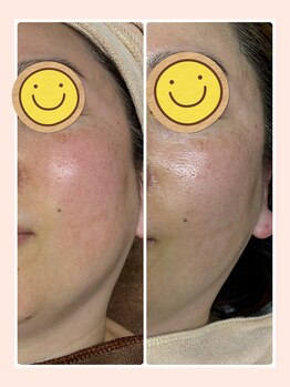 ビューティサロン ココモ(Cocomo)/before・after