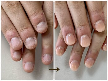 リネイル 川越(Re:NAIL)の写真/深爪・噛み癖・むしり癖卒業！自爪育成で自信が持てる指先に♪その日に見た目改善！