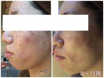 ピリナ 名古屋/【ニキビケア症例】名古屋/栄