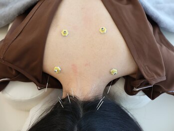 ハリカ 神戸三宮(harica)/置鍼(5~10分時間を置きます)