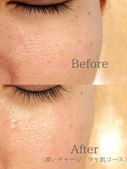 ユイット(huit)の写真/冬ダメージを溜め込んだ毛穴、そのゴワつき・ザラつき放置していませんか？角質から整える春前毛穴ケア