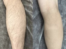 脱毛専門サロン エリクサー(Elixir)/Before After