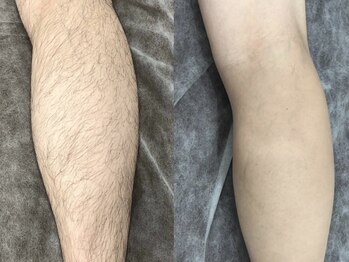 脱毛専門サロン エリクサー(Elixir)/Before After