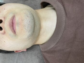 ナノハナ/鹿沼市全身脱毛美容室ナノハナ