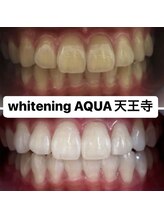 アクア 天王寺店(AQUA)/セルフホワイトニング効果