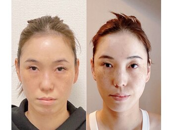 小顔22 ボルティ 本店(Bolty)/【悩み】面長、Fライン