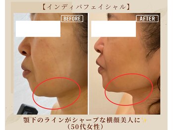 オキシー グレイス 黒崎店(OXY Grace)/インディバフェイシャル